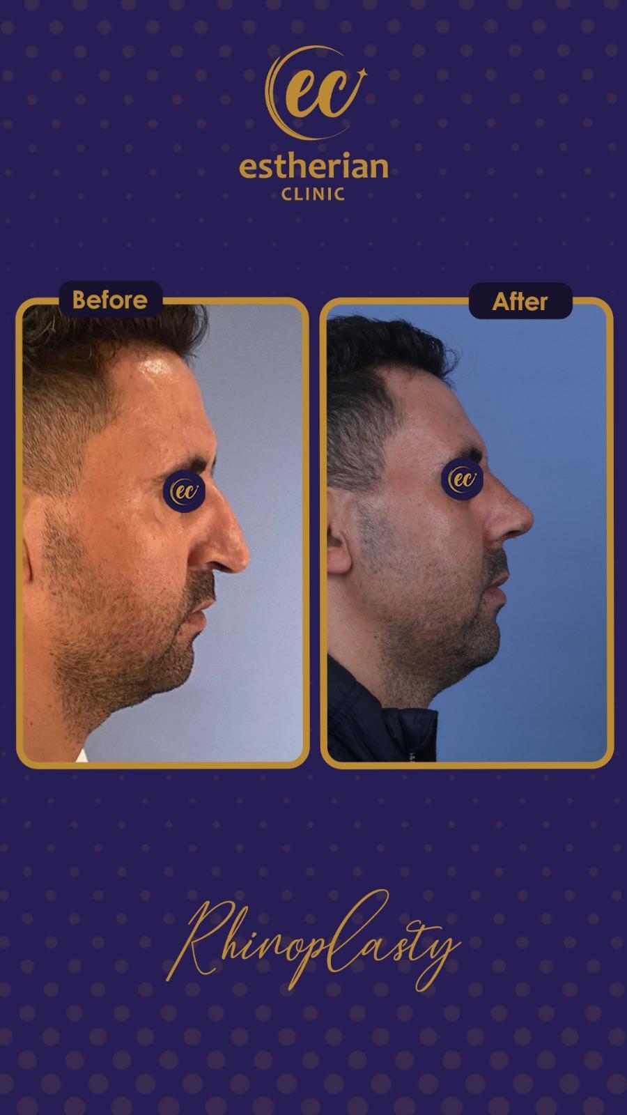 estherian Face Surgery 19-min