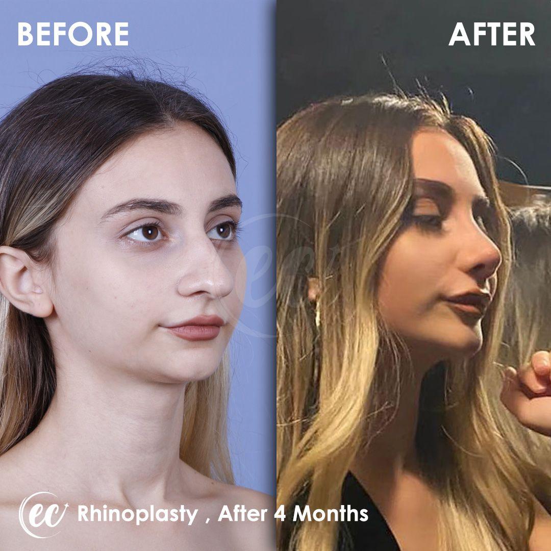 estherian Face Surgery 23-min