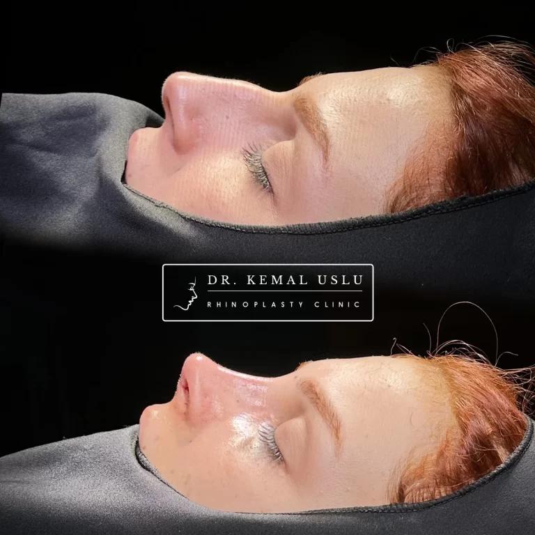 Dr Kemal Uslu Rhinoplasty
