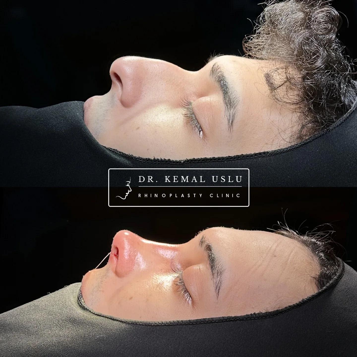 Dr Kemal Uslu Rhinoplasty