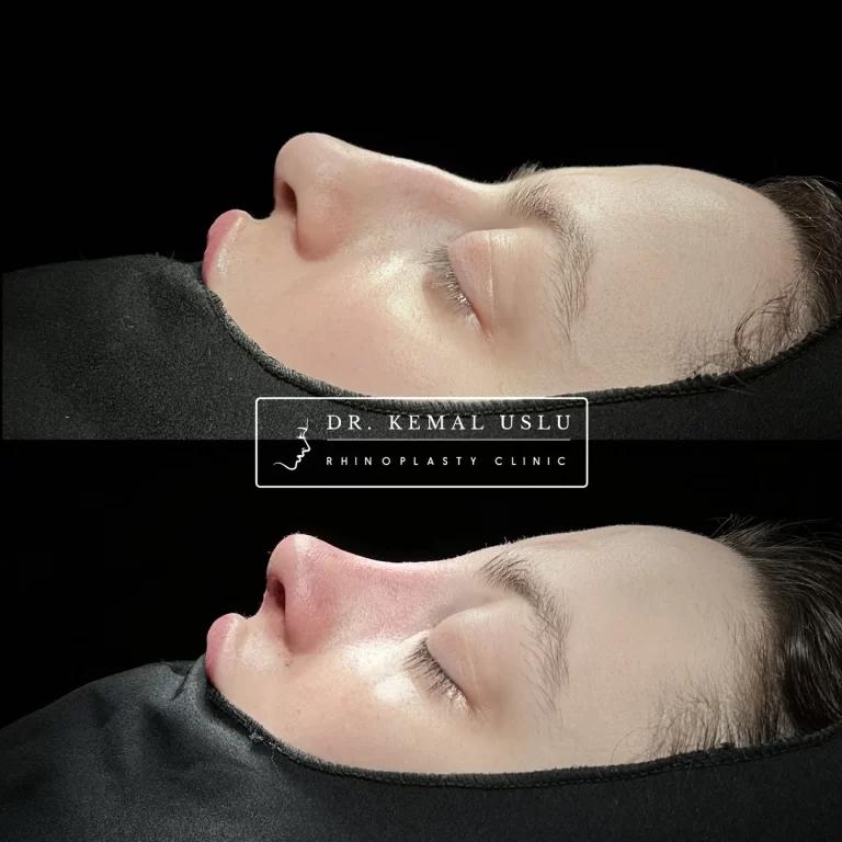 Dr Kemal Uslu Rhinoplasty