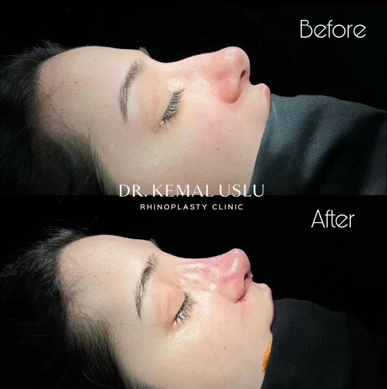 Dr Kemal Uslu Rhinoplasty
