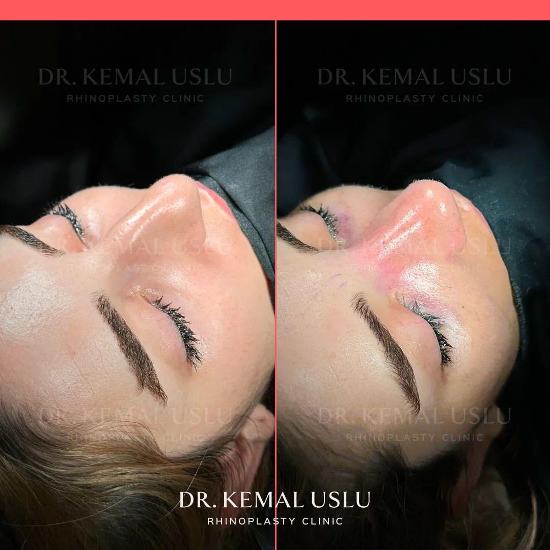 Dr Kemal Uslu Rhinoplasty