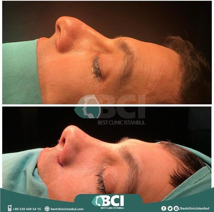 ELIT CLINIC COSMETIC SURGERY RESULTS 12