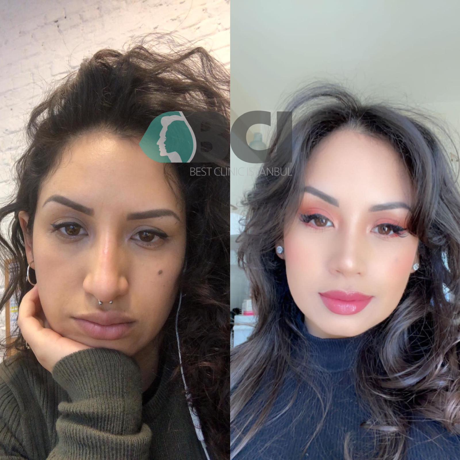 ELIT CLINIC COSMETIC SURGERY RESULTS 9