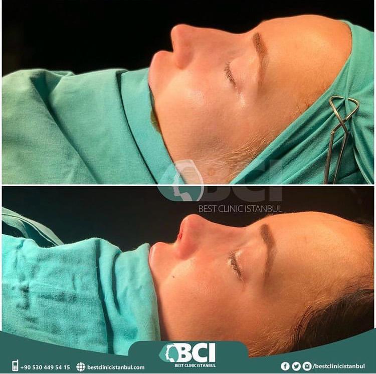 ELIT CLINIC COSMETIC SURGERY RESULTS 10