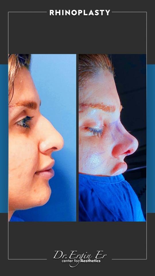DR ERGIN ER ISTANBUL RHINOPLASTY3
