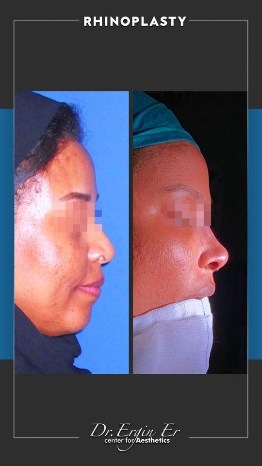 DR ERGIN ER ISTANBUL RHINOPLASTY6