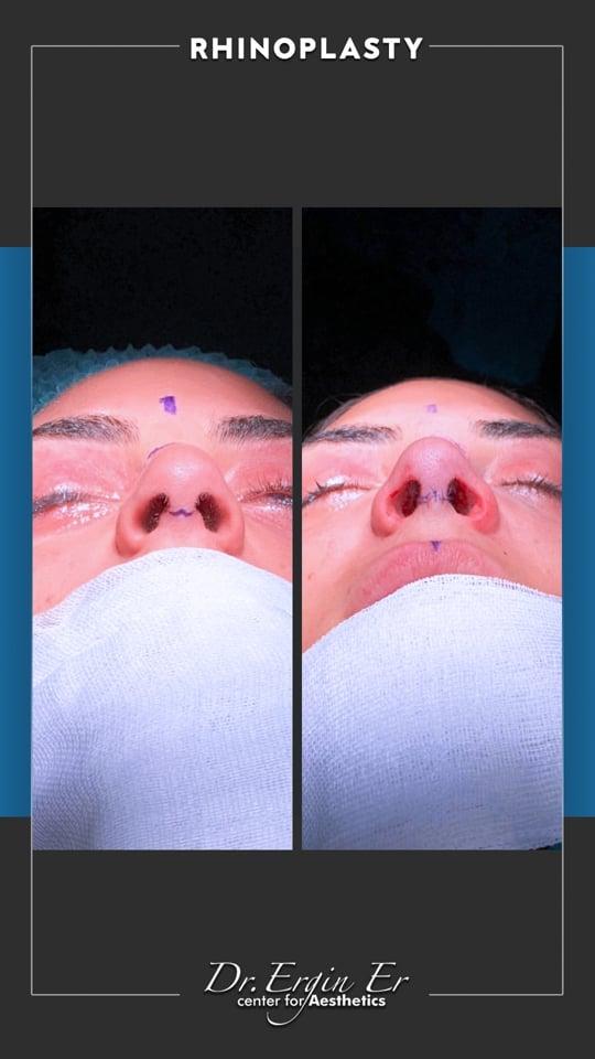 DR ERGIN ER ISTANBUL RHINOPLASTY4