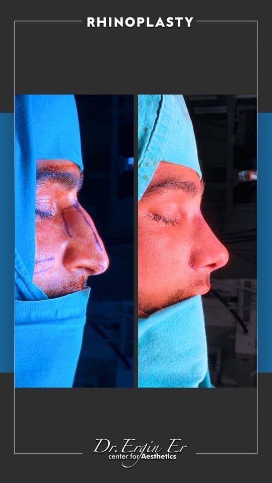 DR ERGIN ER ISTANBUL RHINOPLASTY2