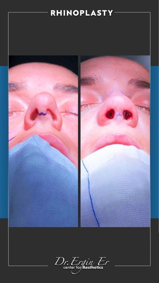 DR ERGIN ER ISTANBUL RHINOPLASTY7
