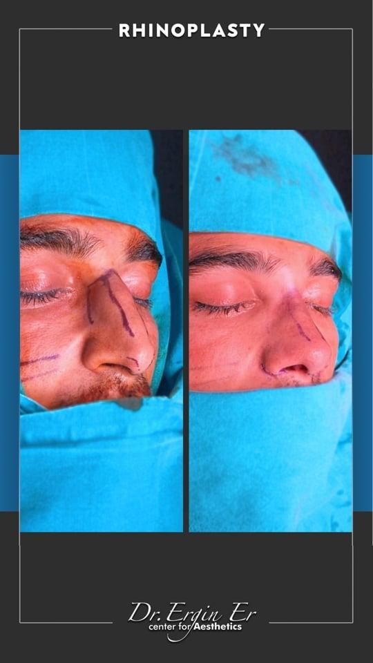 DR ERGIN ER ISTANBUL RHINOPLASTY1