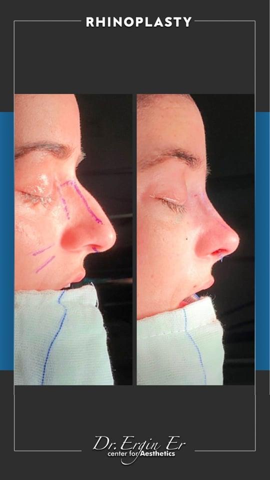 DR ERGIN ER ISTANBUL RHINOPLASTY8