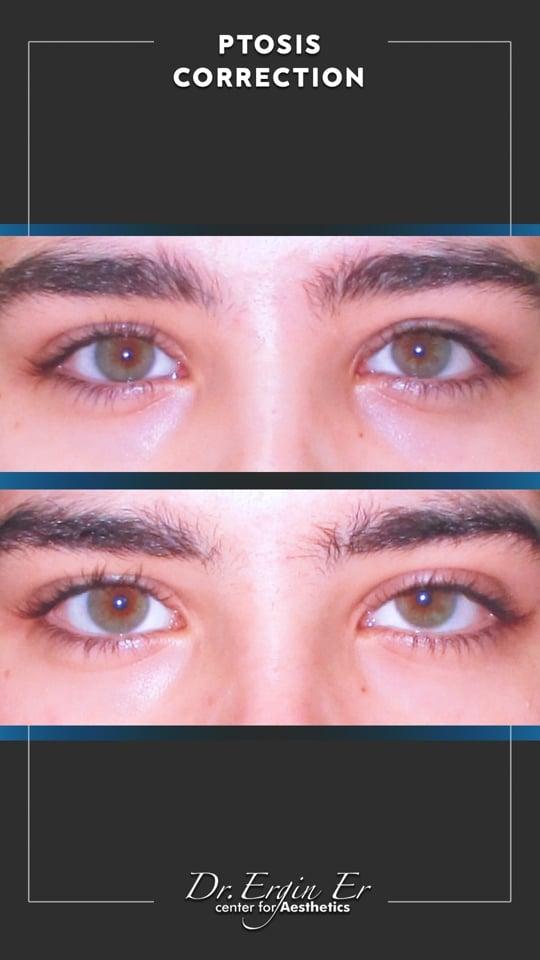 DR ERGIN ER ISTANBUL RESULTS SURGERY 34