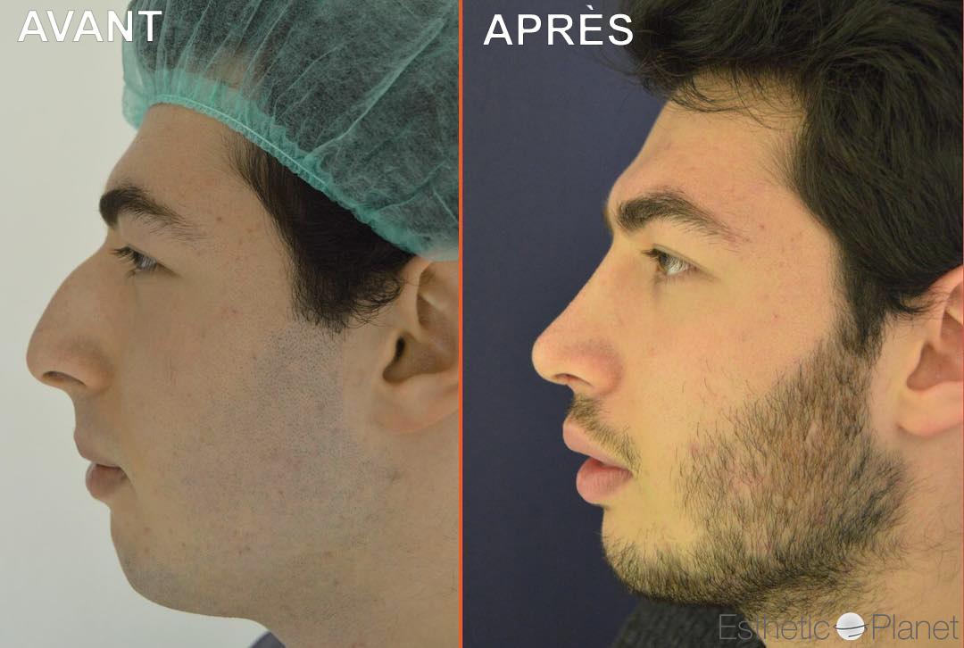 Rhinoplastie by Dr Ergin Er