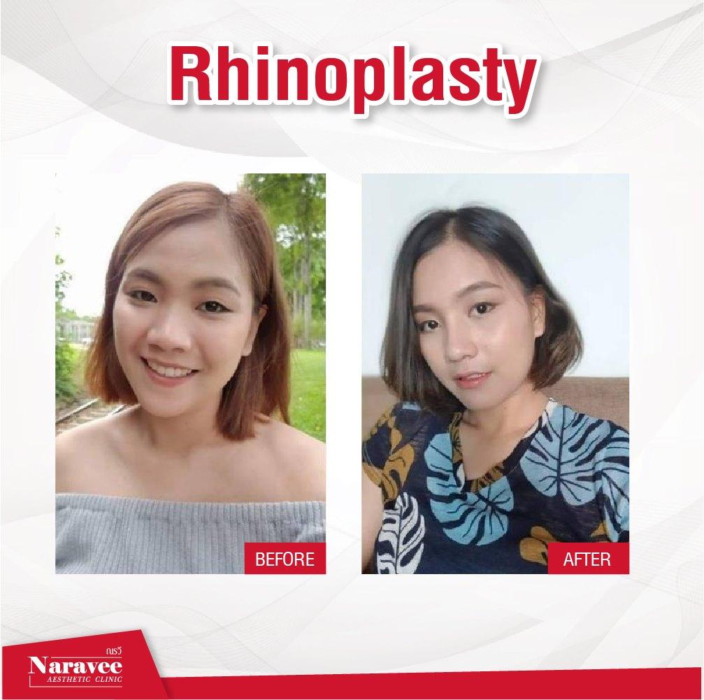 rhinoplastie2-min
