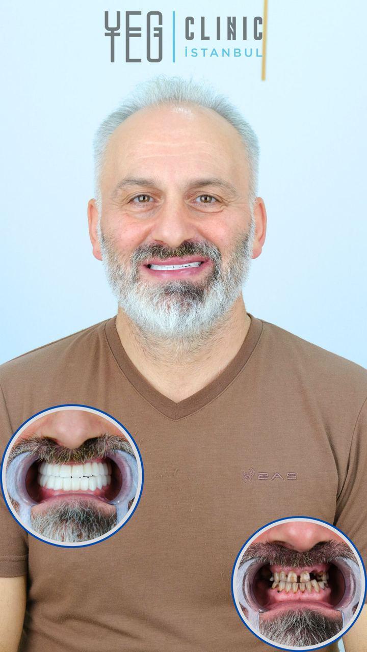 Dental implants