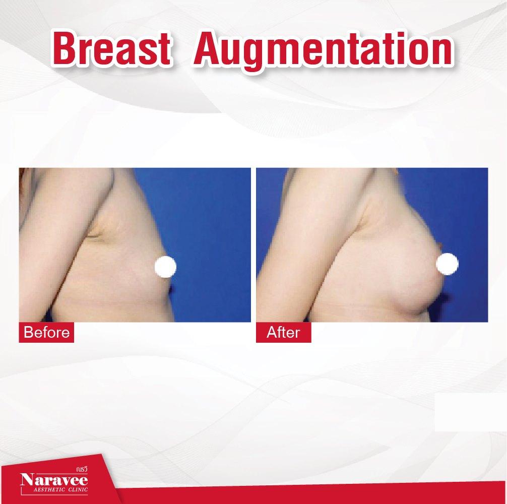 augmentation-mammaire2-min