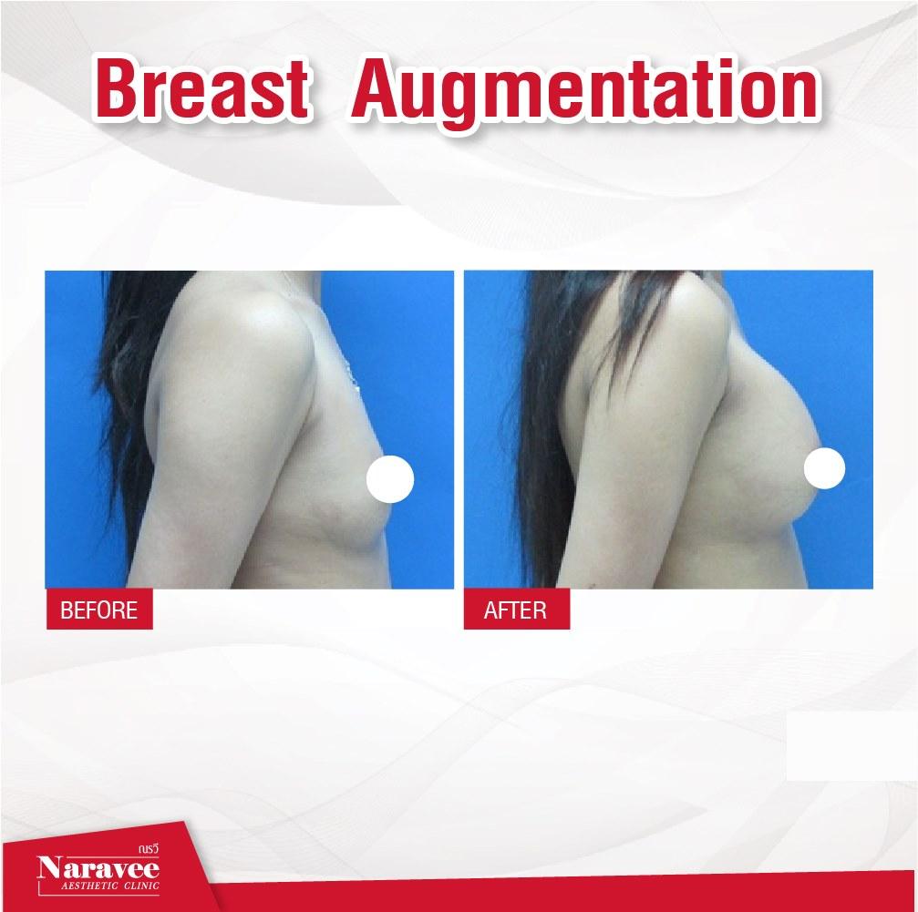 augmentation-mammaire3-min