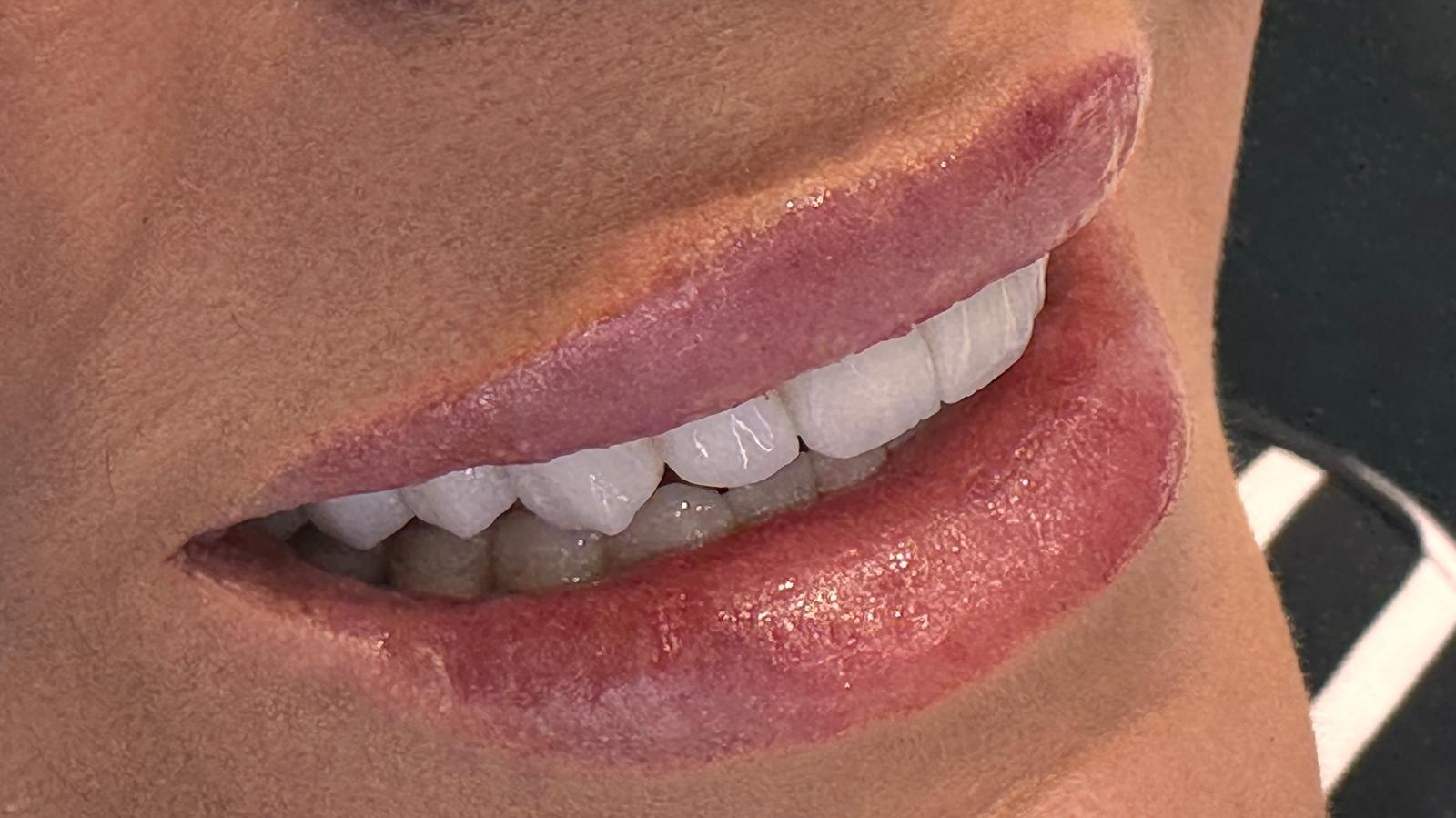 Emax Veneers