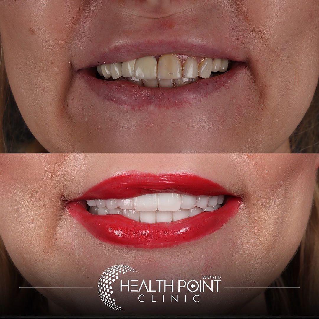 Dental implants