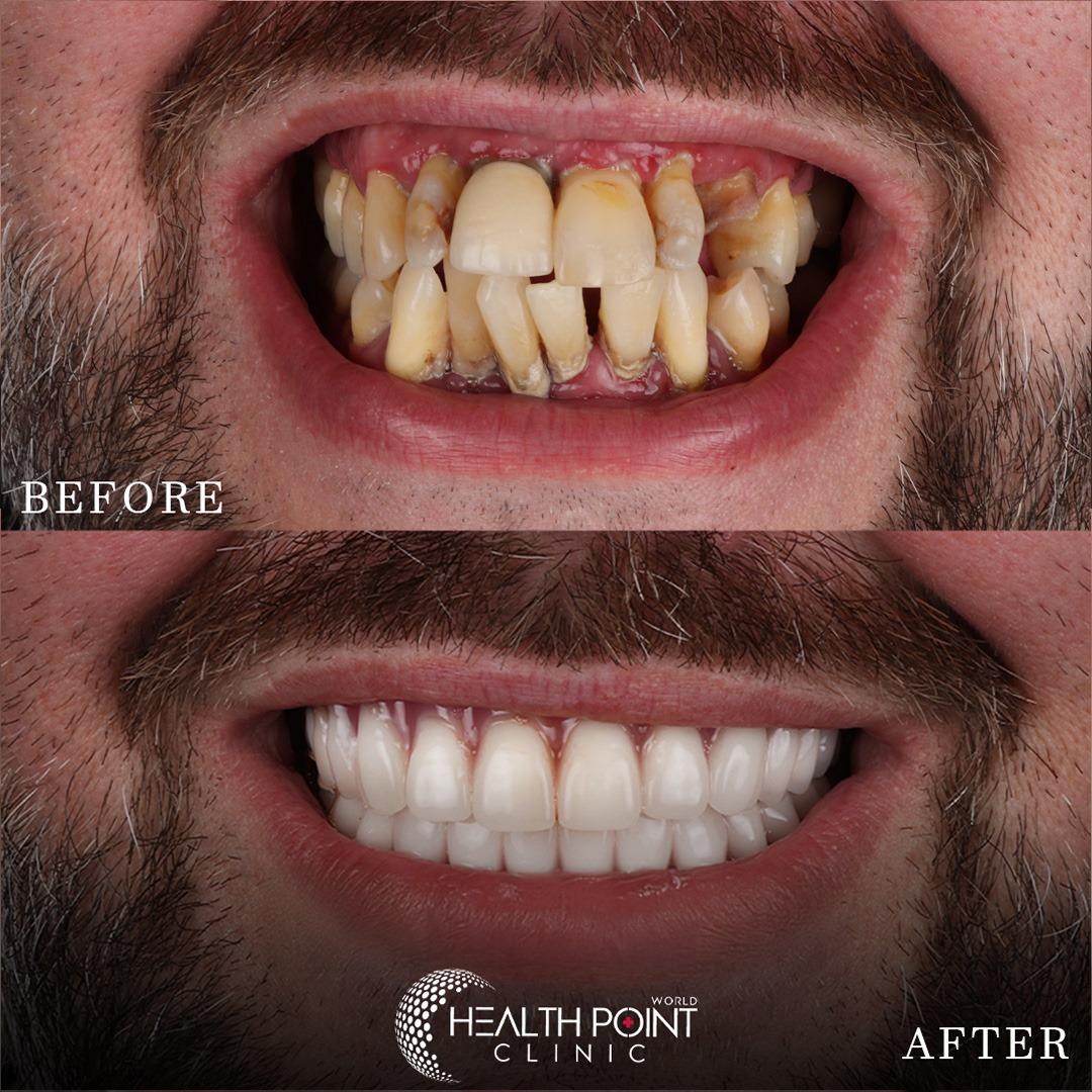 Dental implants