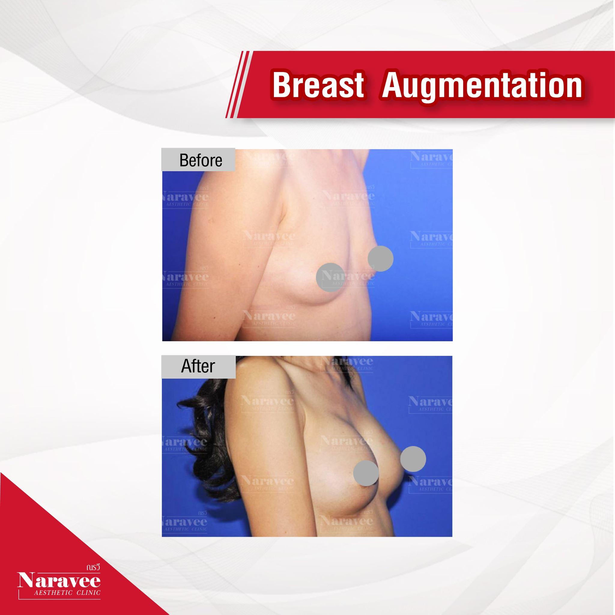 augmentation-mammaire-min