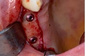 implant raja