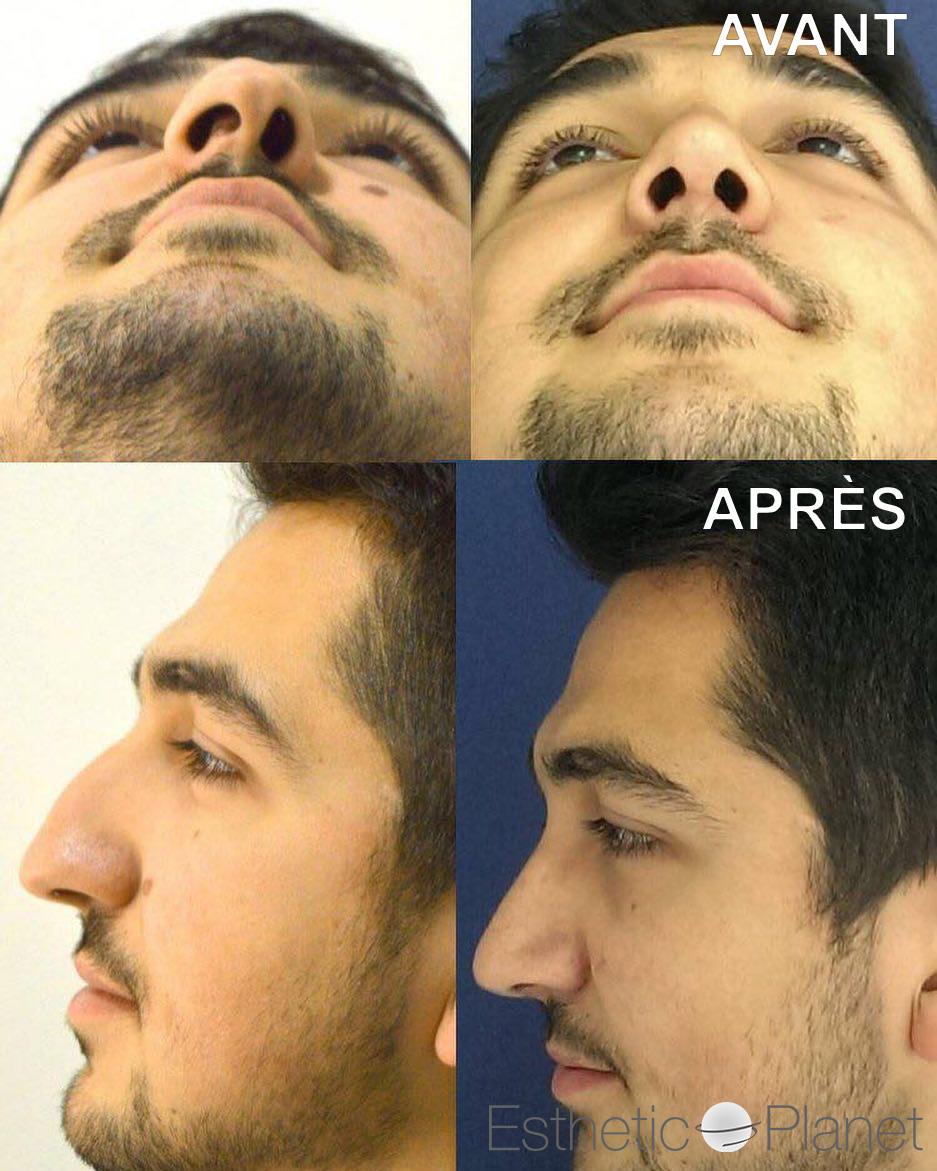 Rhinoplastie by Dr Ergin Er