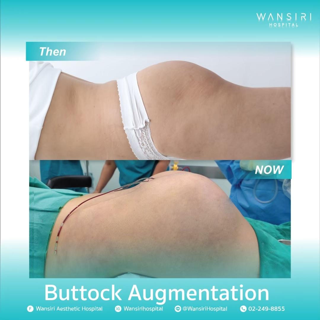 Wansiri Hospital Bangkok Butt Implants