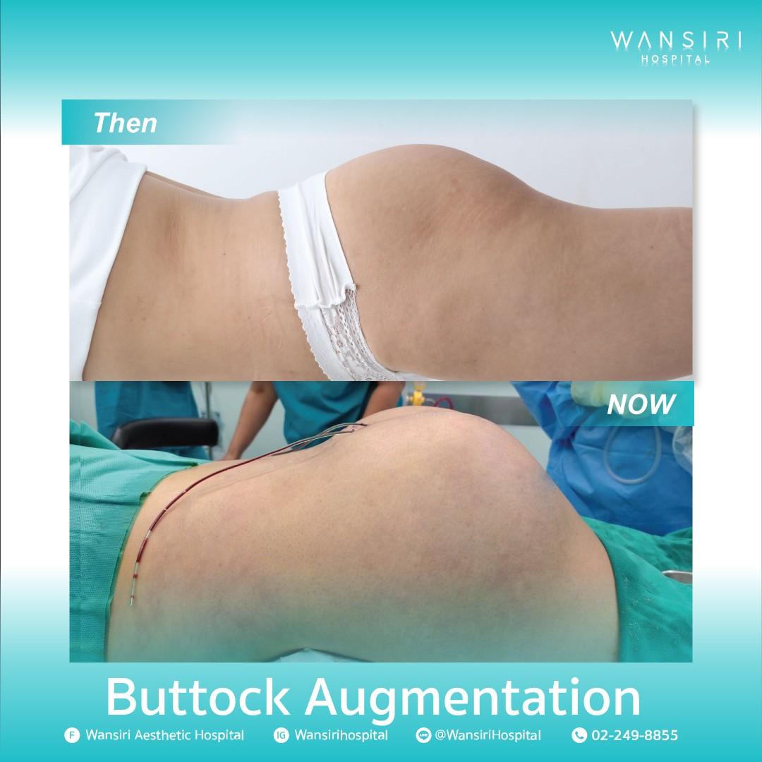 LINE_ALBUM_Buttock Augmentation_250515_2
