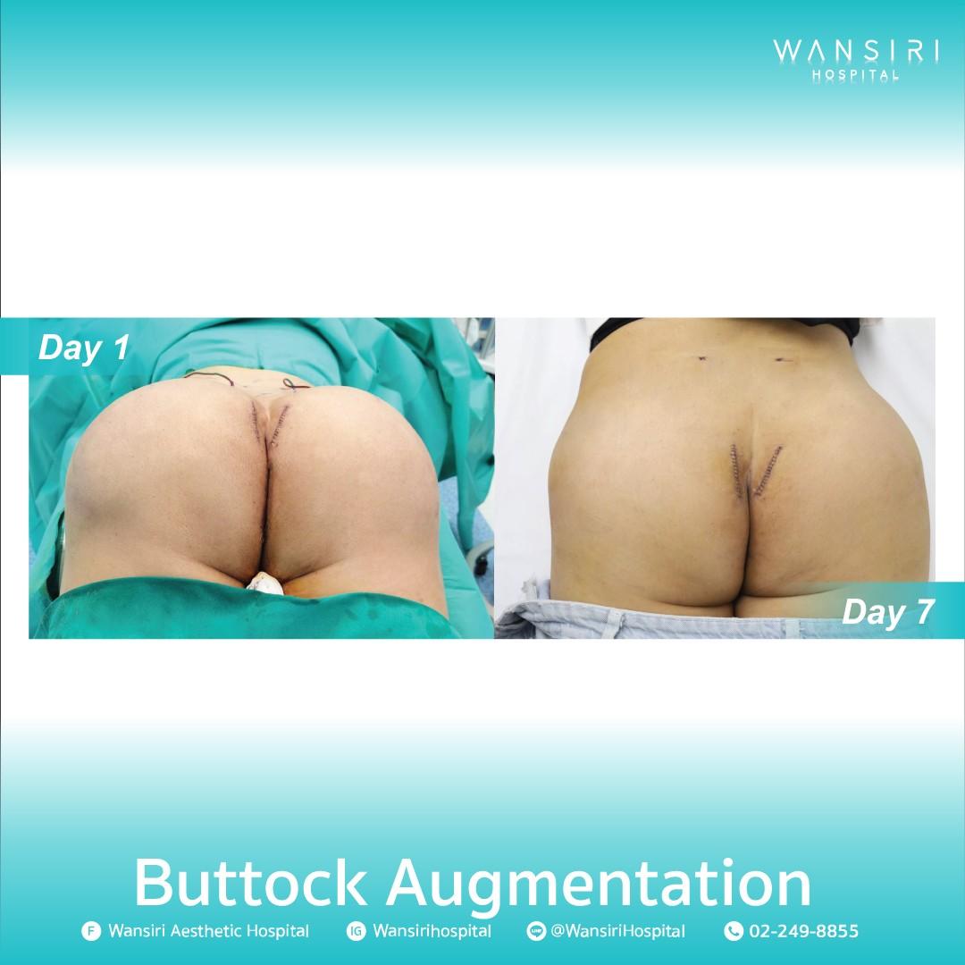 LINE_ALBUM_Buttock Augmentation_250515_3
