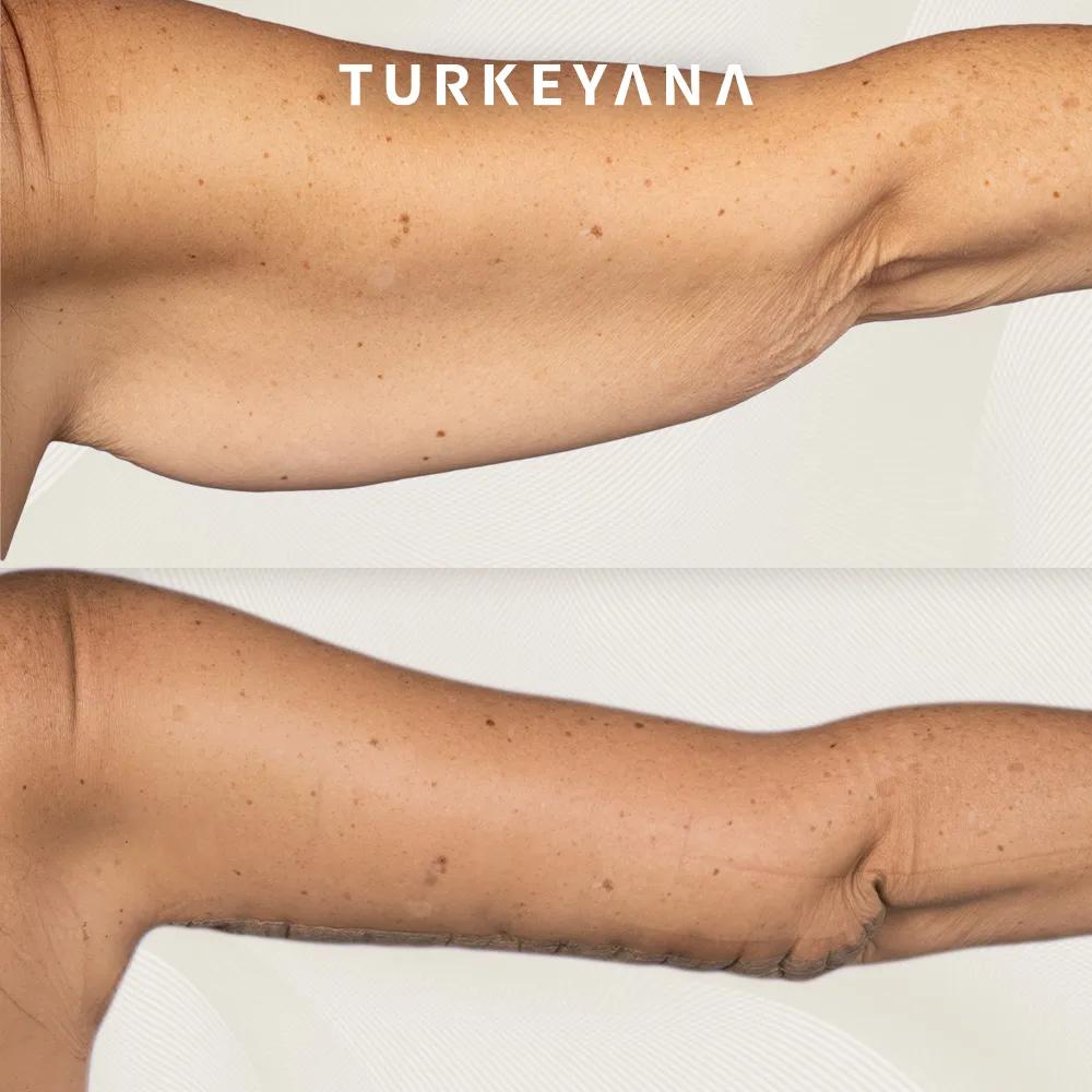 arm lift istanbul