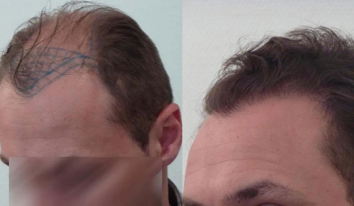 3000 FUT By Dr Beyhan Zeybek