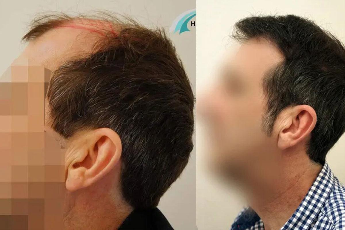 3800 FUT by Dr Beyhan