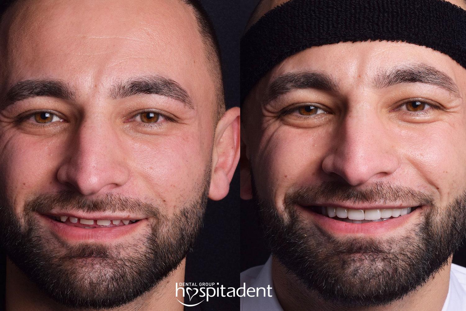 Dental Emax veneers : Facettes dentaires1