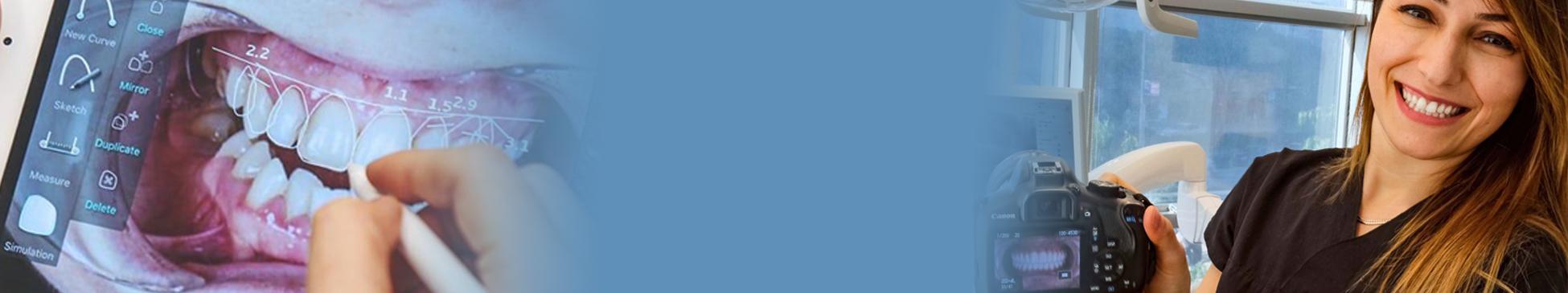 Guida alle faccette dentali banner