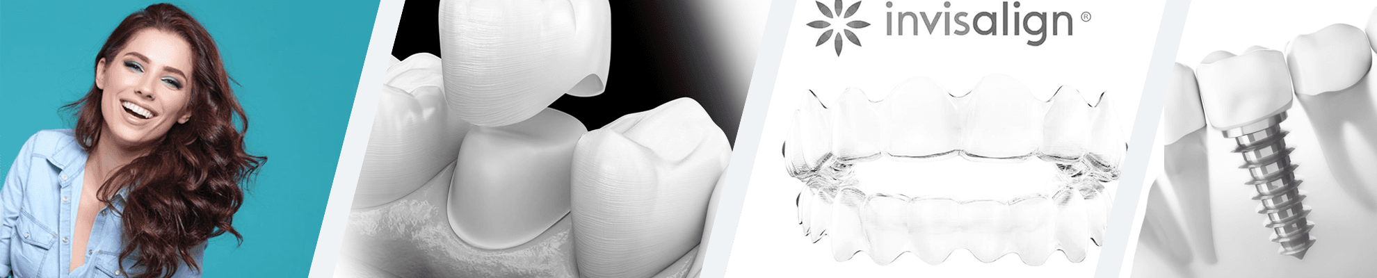 Cure odontoiatriche in Ungheria e Türkiye: impianto, corona, rivestimento banner