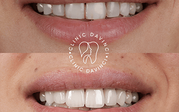 Hollywood Smile