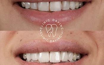 Hollywood Smile