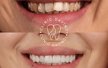 Dental Veneers
