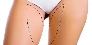 THIGH LIFT
