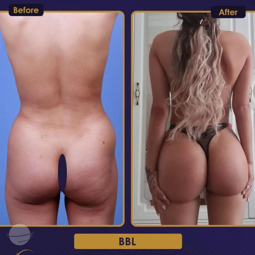 BBL Lipofilling fessier