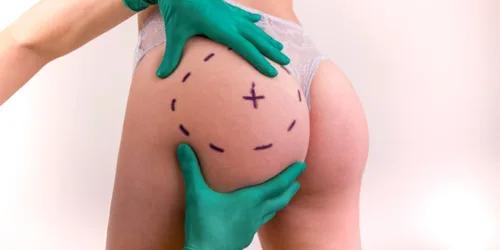Buttocks implants
