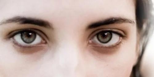 Blepharoplasty Local Anesthesia