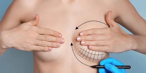 Breast lift without implants