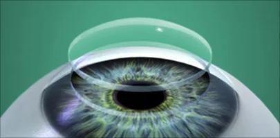 Keratoplastie - Corneal Transplantation
