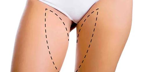THIGH LIFT