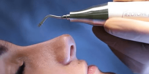 Ultrasonic Rhinoplasty