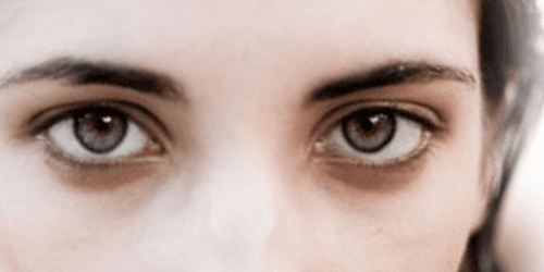 Blepharoplasty up or down